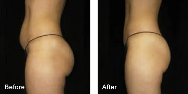 Aesthetic & Wellness Clinic Brookfield WI Weight Loss Results Before And After Belly
