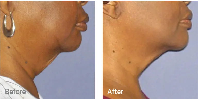 Aesthetic & Wellness Clinic Brookfield WI Weight Loss Results Before And After Chin