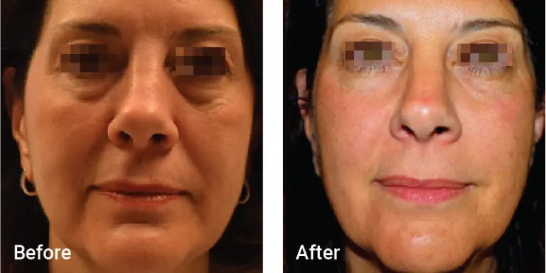 Aesthetic & Wellness Clinic Brookfield WI Weight Loss Results Before And After Face