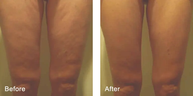 Aesthetic & Wellness Clinic Brookfield WI Weight Loss Results Before And After Legs