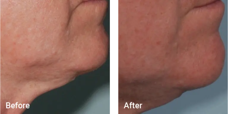 Aesthetic & Wellness Clinic Brookfield WI Weight Loss Results Before And After Neck And Chin