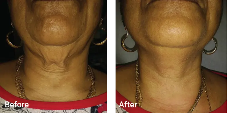 Aesthetic & Wellness Clinic Brookfield WI Weight Loss Results Before And After Neck