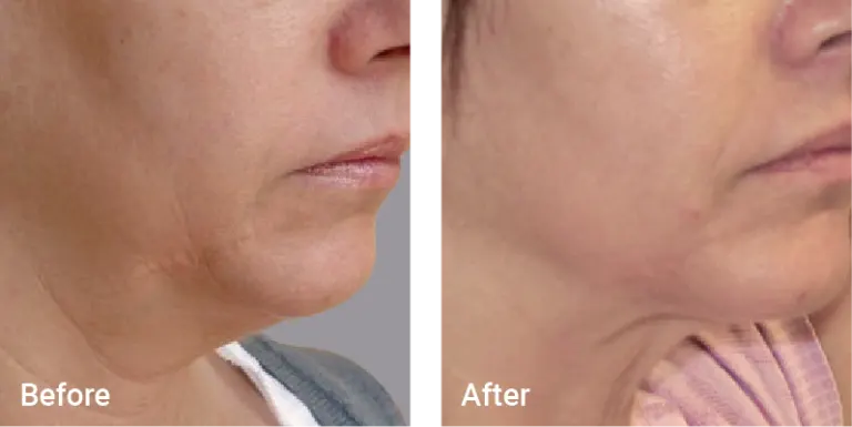 Aesthetic & Wellness Clinic Brookfield WI Weight Loss Results Before And After Side Chin
