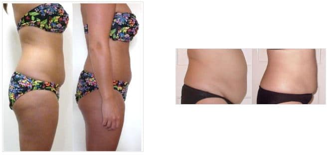 Weight Loss Brookfield WI Before And After Belly Woman