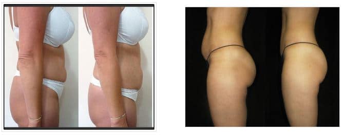 Weight Loss Brookfield WI Before And After Butt