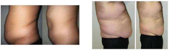 Weight Loss Brookfield WI Before And After Man Belly